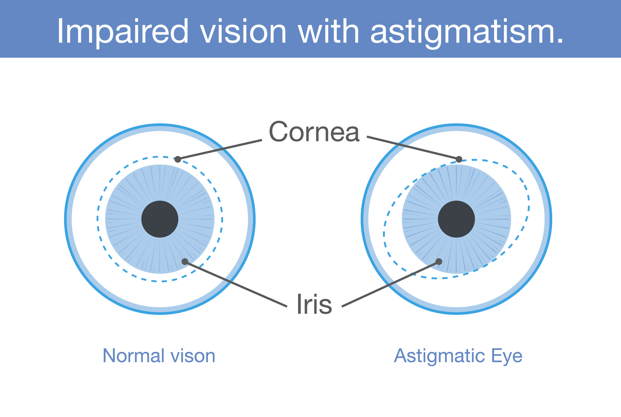 astigmatism-the-canadian-association-of-optometrists