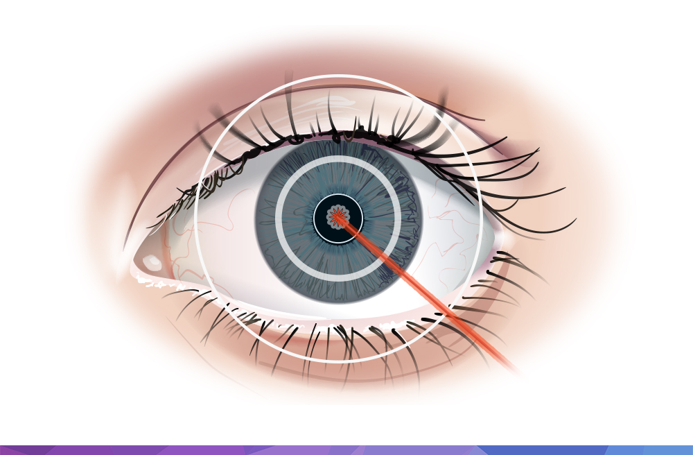 Illustration of a Refractive Eye Surgery