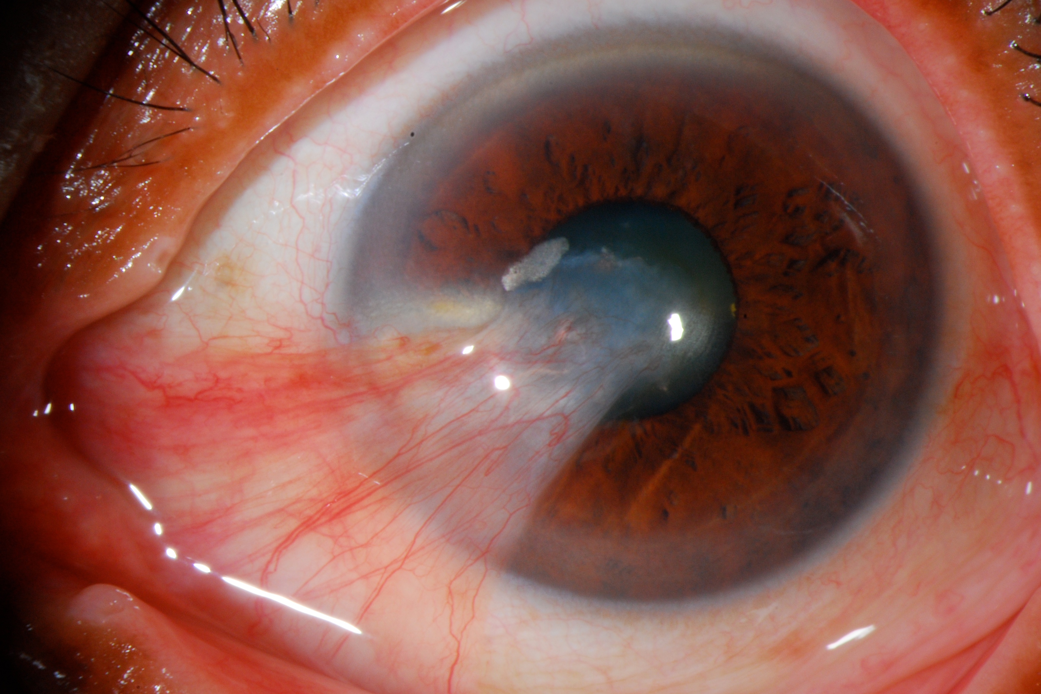 Pterygium Canadian Association Of Optometrists