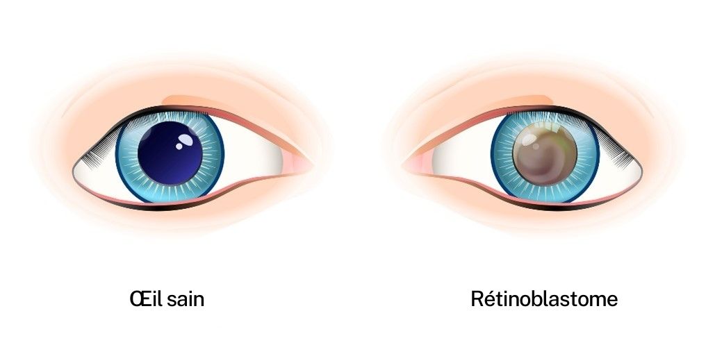 iStock-1396450635 retinoblastoma.FR_.jpg