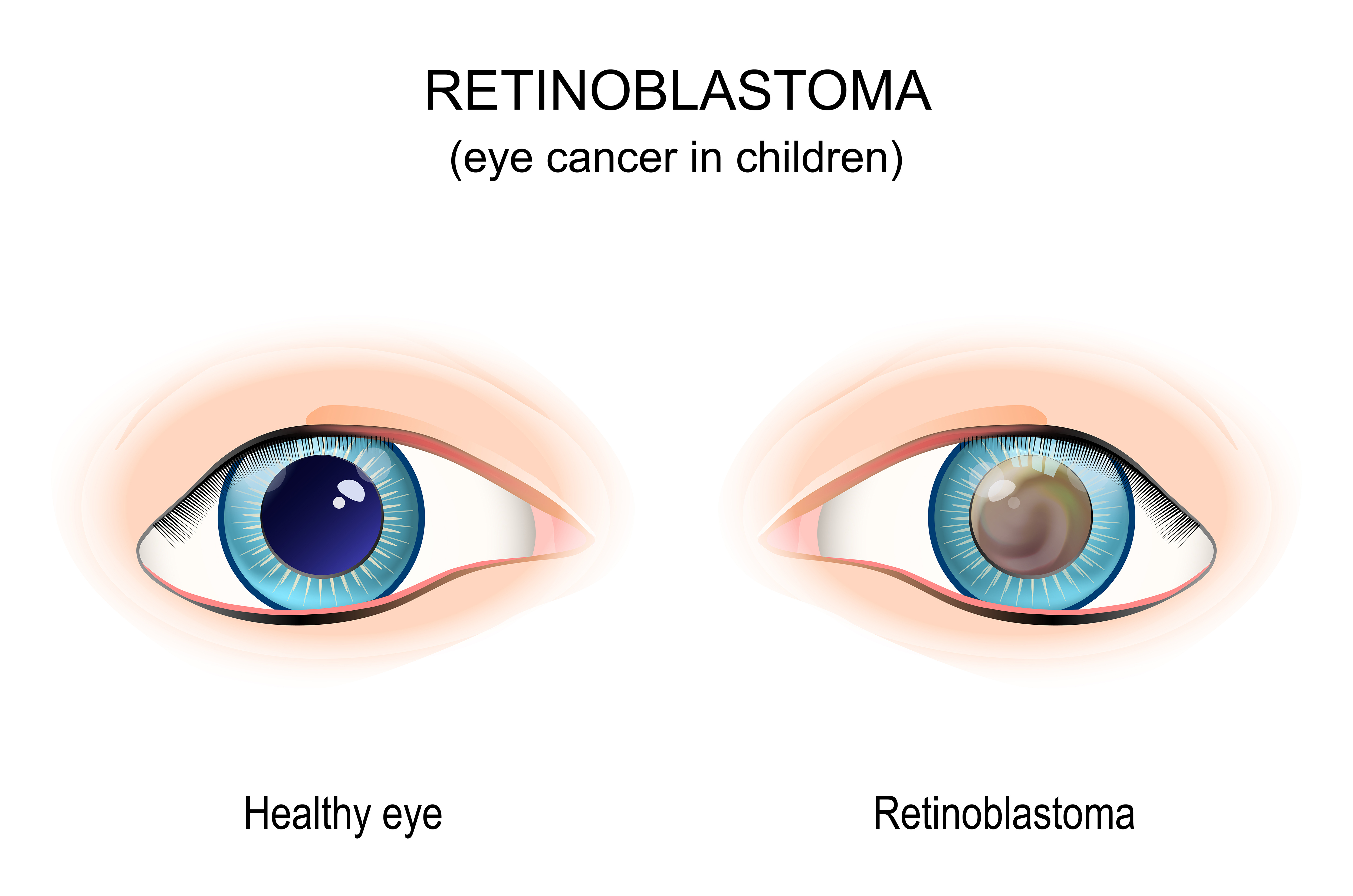 iStock-1396450635 retinoblastoma.eps_.