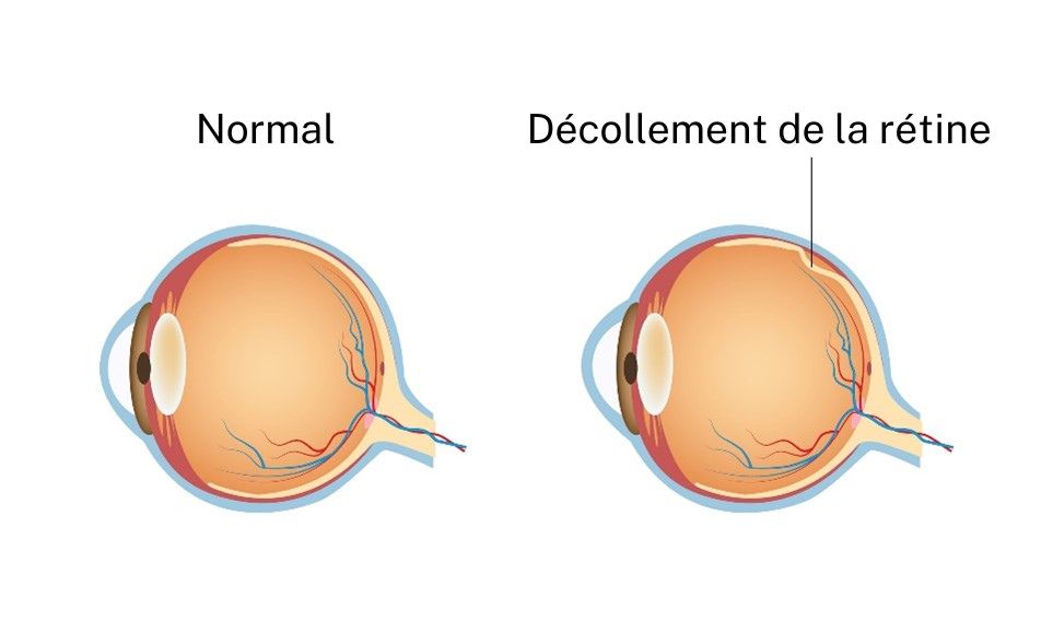 iStock-1673551027_Retinal detachment. FR