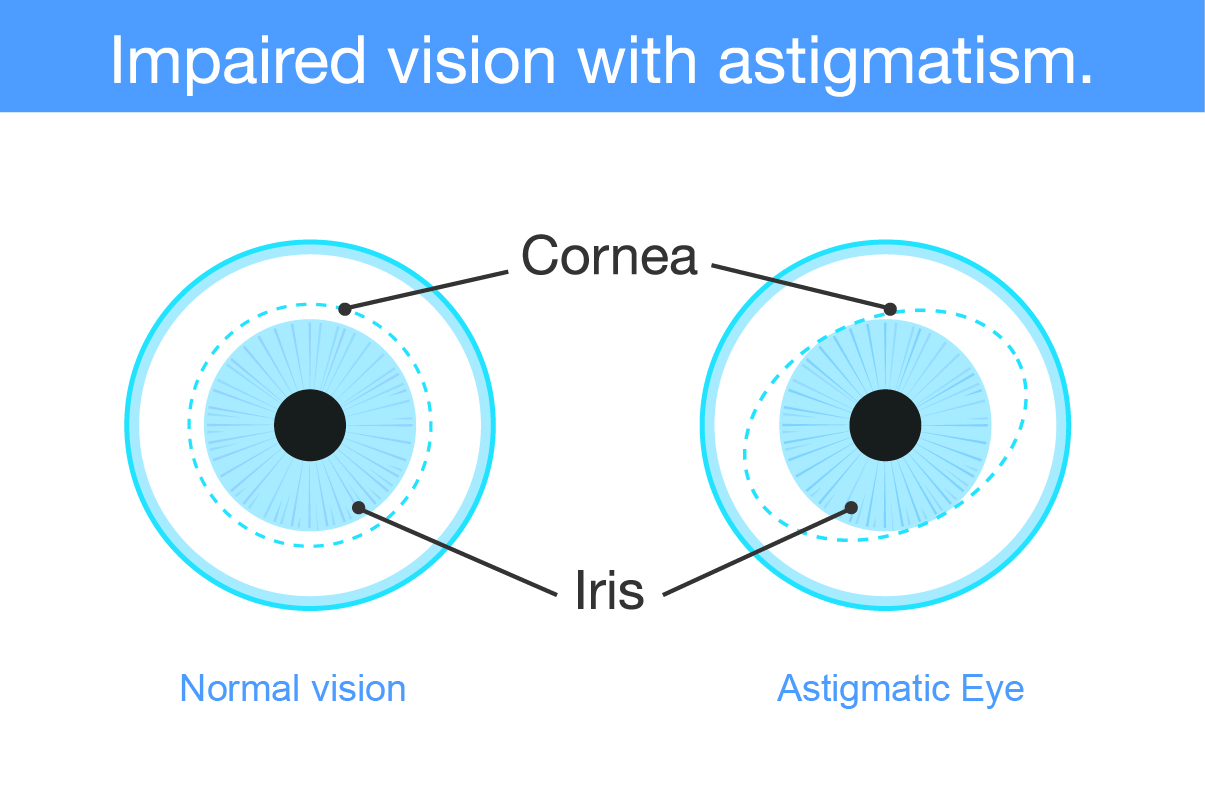 Graphic, titled impaired vision with astimatism, shows the cornea and iris of two eyes, one of the left is titled normal vision, the one on the right is titles astigmatic eye