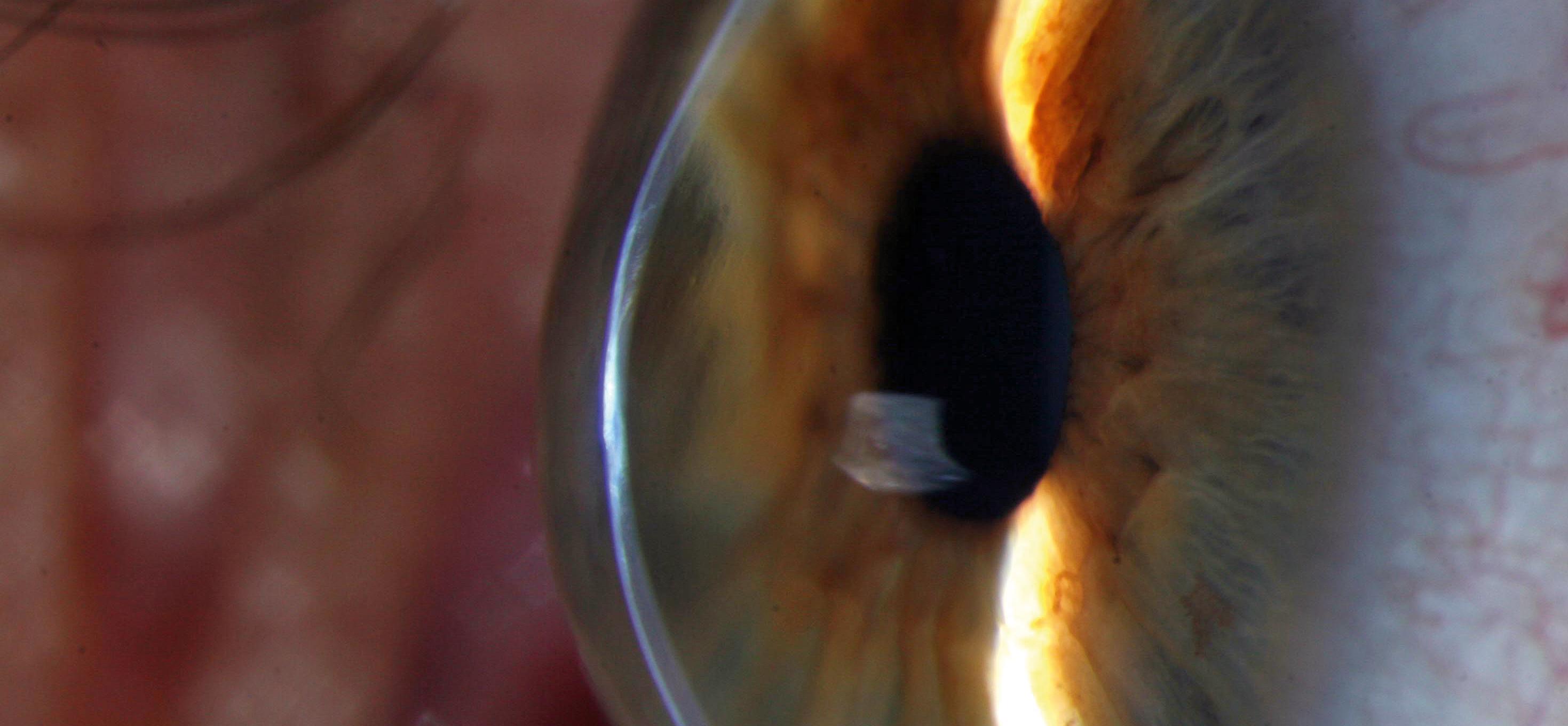 Keratoconus | The Canadian Association Of Optometrists